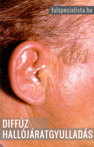 Diffúz hallójárat gyulladás otitis externa