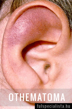 fülsérülés oka othematoma kezelése