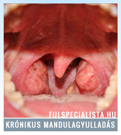 krónikus mandulagyulladás megnagyobbodott mandulák