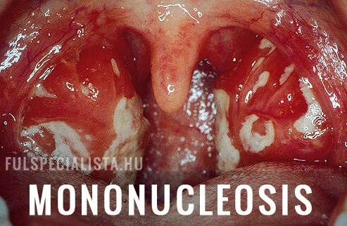 mandula mononucleosis fertőzés kezelés