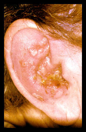 gombás hallójárat gyulladás Otomycosis otitis externa 