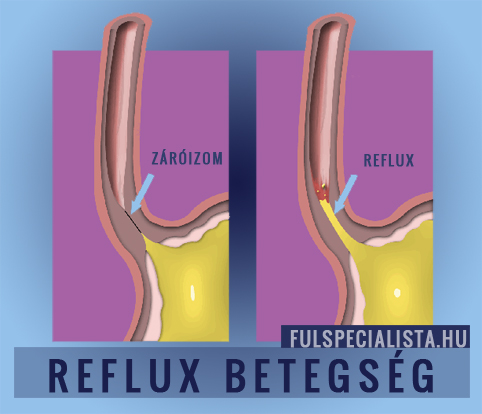 reflux betegség oka kezelése gyomorégés