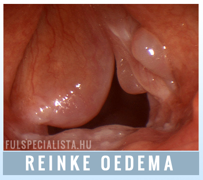 reinke oedema légzési zavar rekedtség